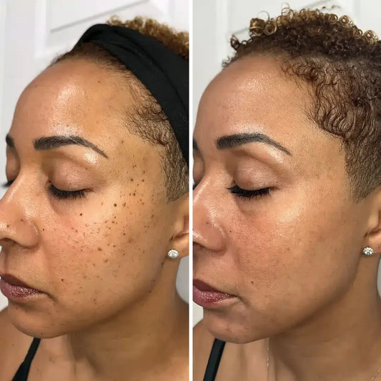 SERYNTHTM ACNE TREATMENTADAPALENE GEL