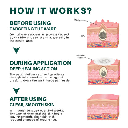 Fivfivgo® Magnesium MicroPin HPV Genital Wart Removal Patch