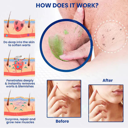Official Store: Fivfivgo NatureErase Instant Mole & Spot Cream