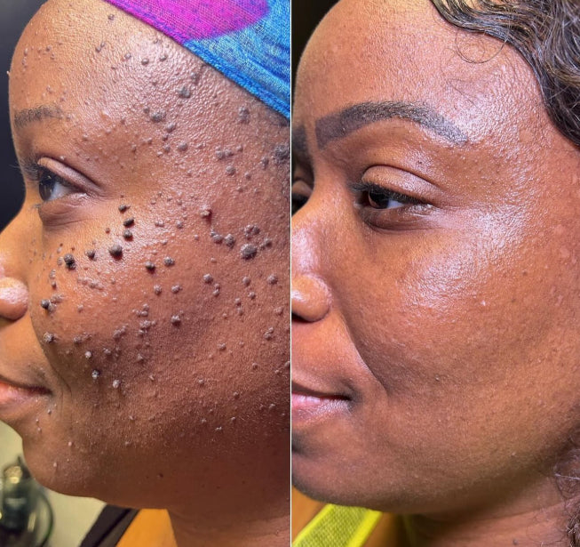 ❄️ Fast-Acting Cryo Formula! ✨ Freeze Blemishes Instantly!  Skin Tag Cryo Treatment Spray
