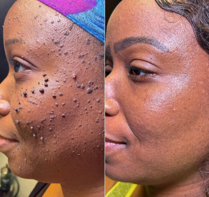 ❄️ Fast-Acting Cryo Formula! ✨ Freeze Blemishes Instantly!  Skin Tag Cryo Treatment Spray