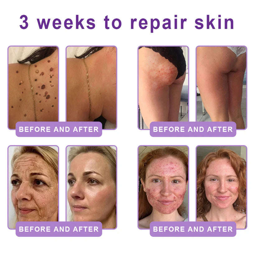 FDA Official: HISKIN PDRN Multi-Peptide Massaging Body RollerCream- Anti-aging, Hydrating, Skin Firming & Lifting, Skin Repair, Even Tone, Acne and Dark Spot Treatment, Wart and Mole Removal, and Psoriasis Relief.