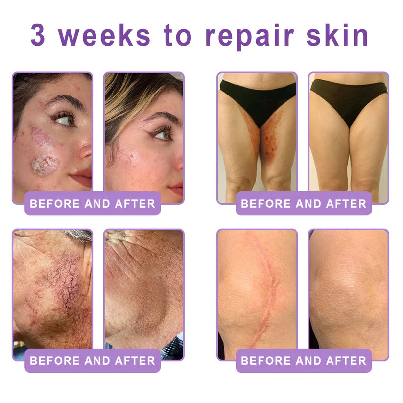 FDA Official: HISKIN PDRN Multi-Peptide Massaging Body RollerCream- Anti-aging, Hydrating, Skin Firming & Lifting, Skin Repair, Even Tone, Acne and Dark Spot Treatment, Wart and Mole Removal, and Psoriasis Relief.