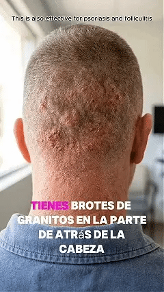 SERYNTHTM ACNE TREATMENTADAPALENE GEL
