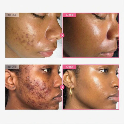 Prandest Arbutin 7% + Tranexamic Acid 4% Cream