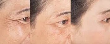 5X Pro-XylaneAnti Aging Mouizturizing Cream