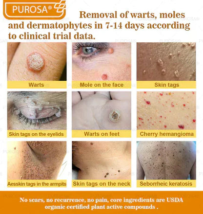 🐝PUROSA® Bee Venom Skin Treatment Cream, Anti-aging, Hydrating, Skin Repair, Even Tone, Acne and Dark Spot Treatment, Wart and Mole Removal, Psoriasis Relief