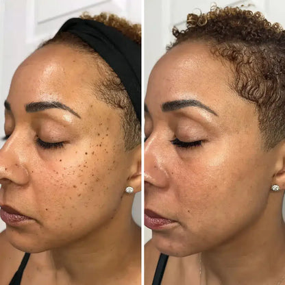 ❄️ Fast-Acting Cryo Formula! ✨ Freeze Blemishes Instantly!  Skin Tag Cryo Treatment Spray